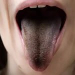 Novos sintomas da Covid 19 incluem Lingua peluda e perda de