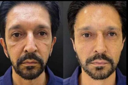 Ricardo Nunes faz harmonizacao facial veja o antes e depois.jpg