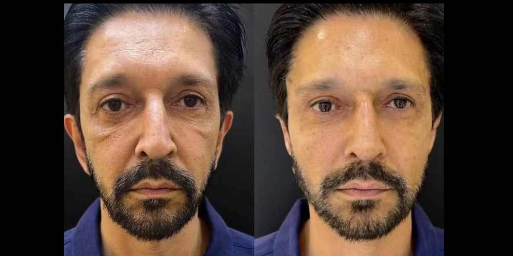 Ricardo Nunes faz harmonizacao facial veja o antes e depois.jpg