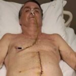 Bolsonaro segue sem movimentos intestinais ha duas semanas e permanece.jpg