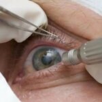 quais-os-riscos-da-cirurgia-que-altera-cor-dos-olhos-pacientes-relatam-dificuldade-de-enxergar-dor-nos-olhos-ardenciadentre-outros-efeitos-foto-pmtb-divulgacao-tvt-news