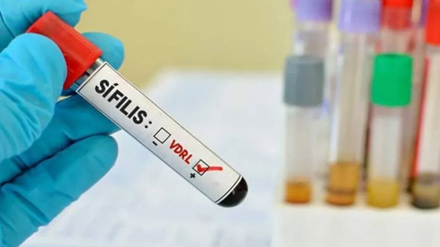 Ministério da Saúde lança campanha de enfrentamento à sífilis 1 ministerio-da-saude-lanca-campanha-de-enfrentamento-a-sifilis-em-2025-a-oferta-do-teste-rapido-hiv-sifilis-aumentou-em-mais-de-40-foto-arquivo-abr-tvt-news