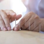 exercicio-profissional-de-acupuntura-e-regulamentado-no-brasil-lei-assegura-o-exercicio-profissional-a-pessoas-com-formacao-superior-em-acupuntura-foto-divulgacao-tvt-news